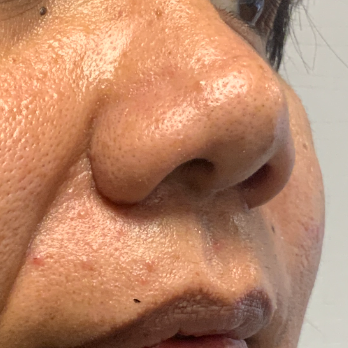 before-and-after-nostril-reduction