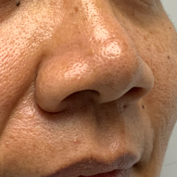 before-and-after-nostril-reduction