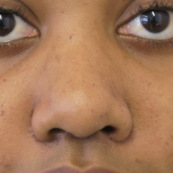 before-and-after-nostril-reduction