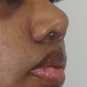 before-and-after-nostril-reduction