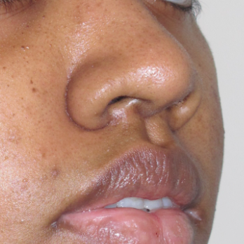 before-and-after-nostril-reduction