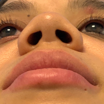 before-and-after-nostril-reduction