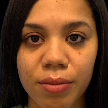 before-and-after-nostril-reduction