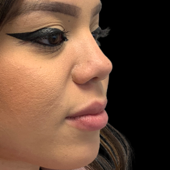 before-and-after-nostril-reduction