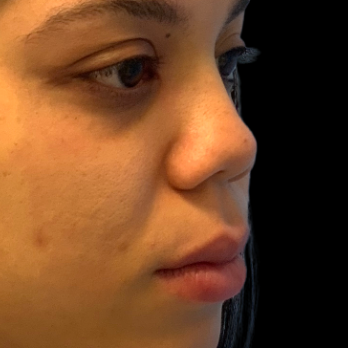 before-and-after-nostril-reduction