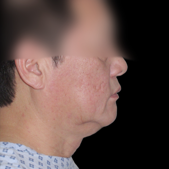 male-facelift-before