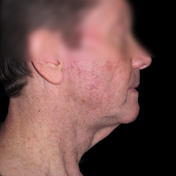 male-facelift-before