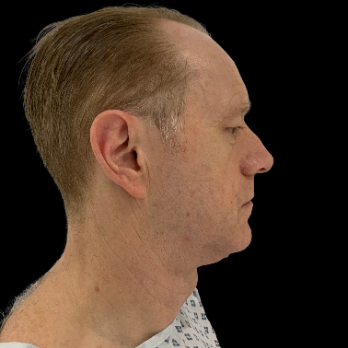 male-facelift-before