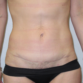 Front view of patient after Abdominoplasty surgery