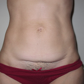 Front view of patient prior to Abdominoplasty surgery