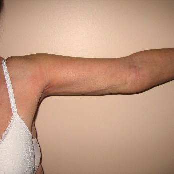 Front view of patient after Brachioplasty Arm Lift surgery