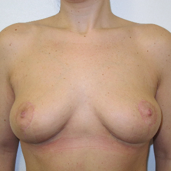 Front view of patient after breast lift surgery