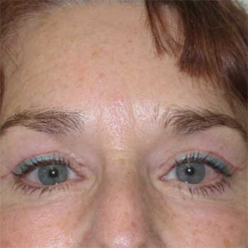 Front view of female patient after browlift surgery