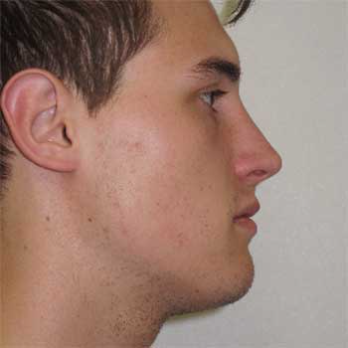 Side view of male patient after chin implant surgery