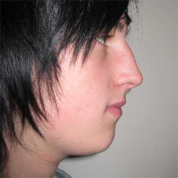 Side view of male patient prior to chin implant surgery