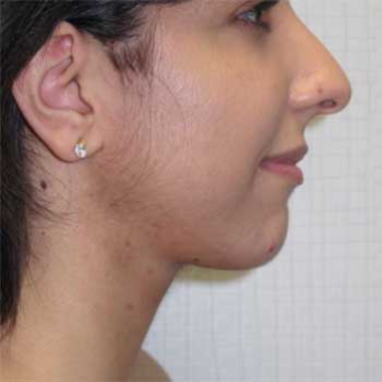 Side view of 30 year old female after Vaser Lipo 