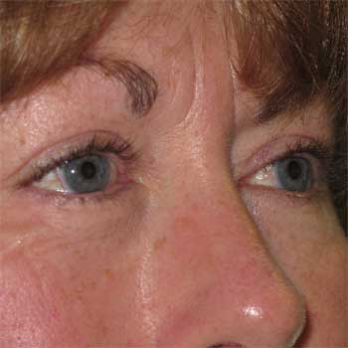 Side view of female patient after eyelid surgery