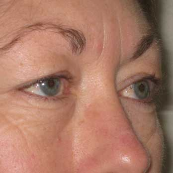 Side view of female patient prior to eyelid surgery