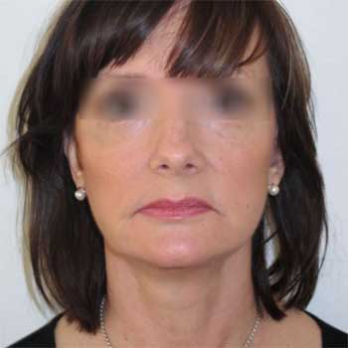 Front view female patient after mini-facelift surgery