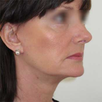 Three quarter after view of mini-facelift surgery