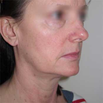 Three quarter before view of mini-facelift female patient