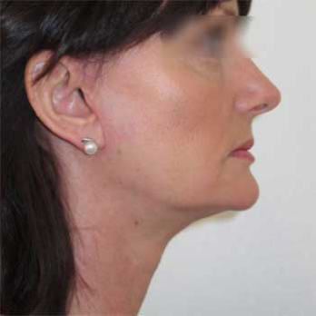 Side view of female patient after mini-facelift surgery