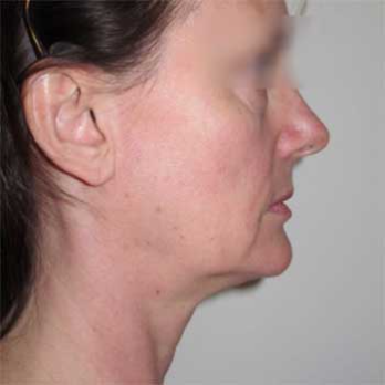 Side view of female paitent before mini-facelift surgery