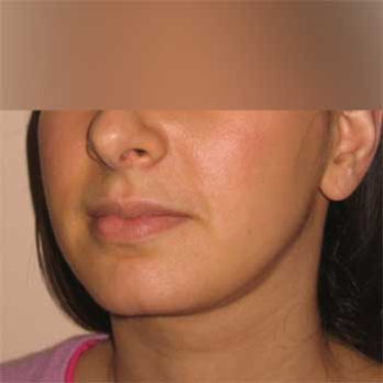 Quarter view female patient after Facial Liposculpture surgery