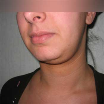 Quarter view female patient prior to Facial Liposculpture surgery