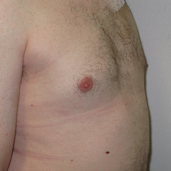 Side view of male patient after gynaecomastia surgery