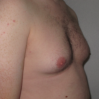 Side view of male patient prior to gynaecomastia surgery