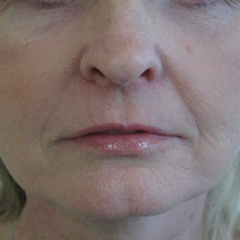 Front view of patient after Fractional laser resurfacing treatment