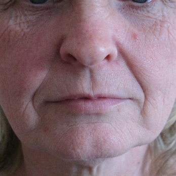 Front view of patient prior to Fractional laser resurfacing treatment