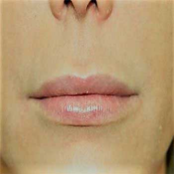 Front view of female patient prior to lip lift surgery