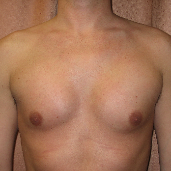 Front view of male patient after pectoral implant surgery