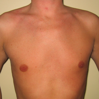 Front view of male patient prior to pectoral implant surgery