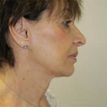 Side view of female patient before neck lift and facelift surgery