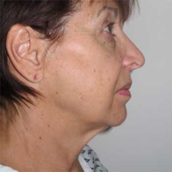 Side view of female patient before neck lift and facelift surgery