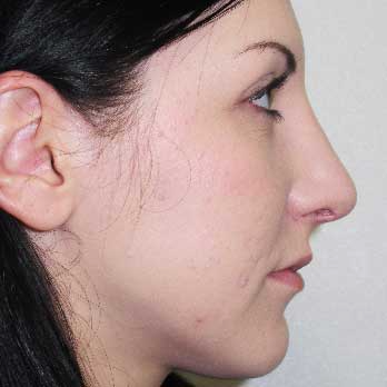 Side profile after rhinoplasty surgery