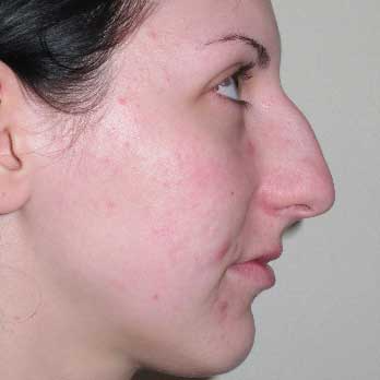 Side profile before rhinoplasty surgery