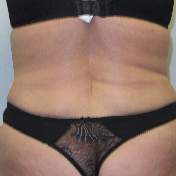 Back view of patient after VASER Liposelection surgery