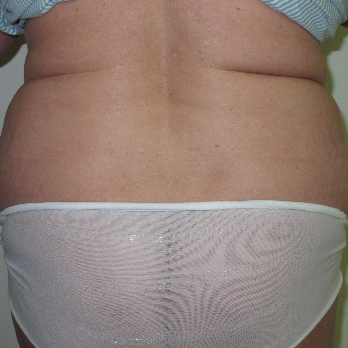 Back view of patient prior to VASER Liposelection surgery