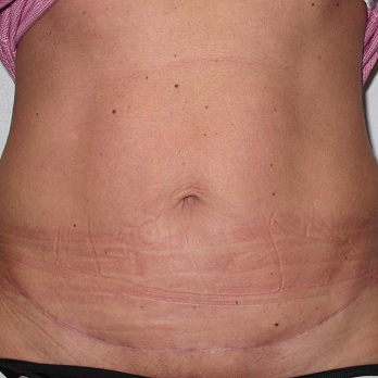 Front view of patient after Abdominoplasty surgery