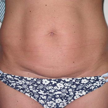 Front view of patient prior to Abdominoplasty surgery