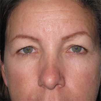 Side view of female patient prior to eyelid surgery