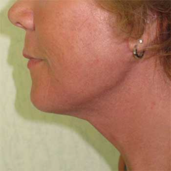 Side view of female paitent after Facelift surgery