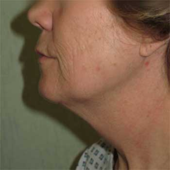 Side view of female paitent before Facelift surgery