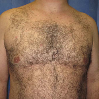 Front view of male patient after gynaecomastia surgery