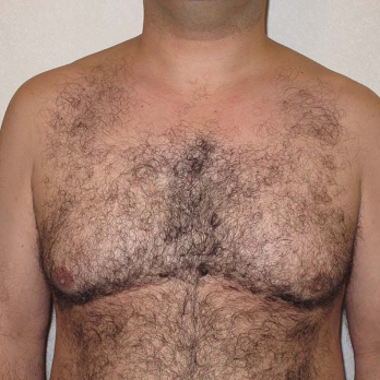 Front view of male patient prior to gynaecomastia surgery