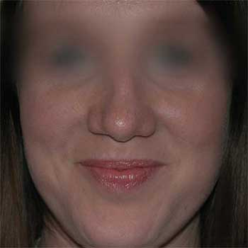 Front view after rhinoplasty surgery